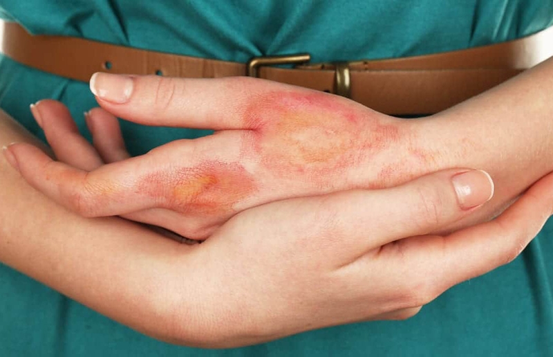 Xử lý vết bỏng bị phồng nước đúng cách để tránh nhiễm trùng