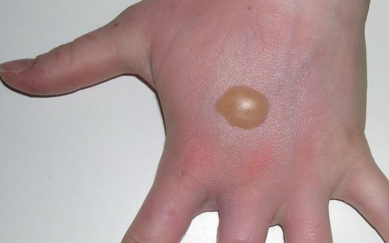 Sơ cứu bỏng sai cách là sai lầm hay gặp phải của nhiều người 3