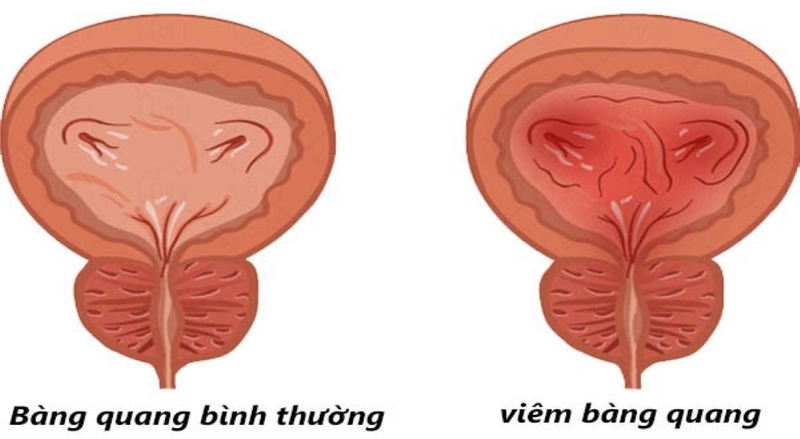Xuất hiện bạch cầu trong nước tiểu – Nguyên nhân do đâu? 2