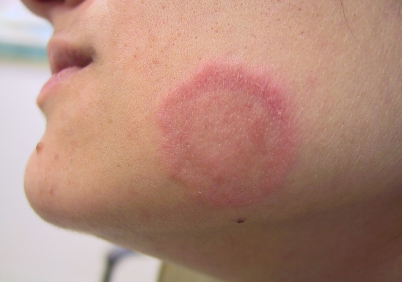 xuat-hien-vet-tron-bi-noi-dom-do-tren-da-va-ngua-la-do-dau 2