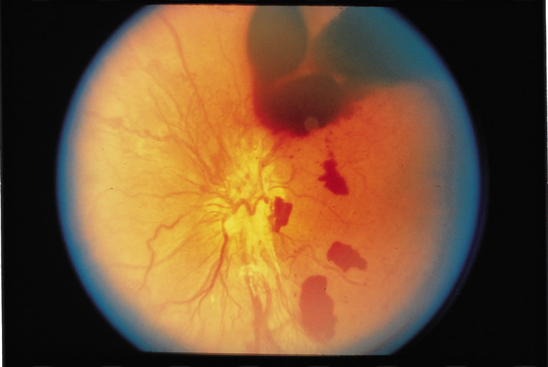 Xuất huyết dịch kính là gì? Triệu chứng nhận biết sớm tình trạng xuất huyết dịch kính 1