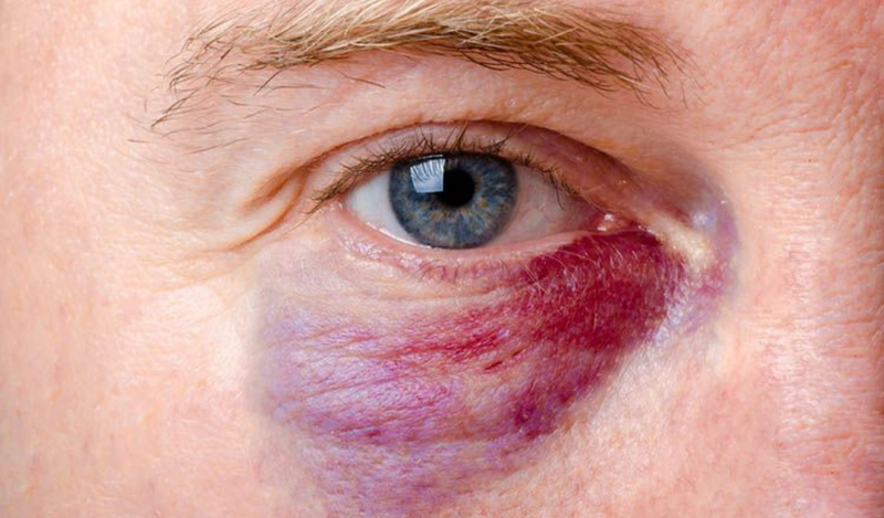 nguyên nhân gây xuất huyết dưới da quanh mắt