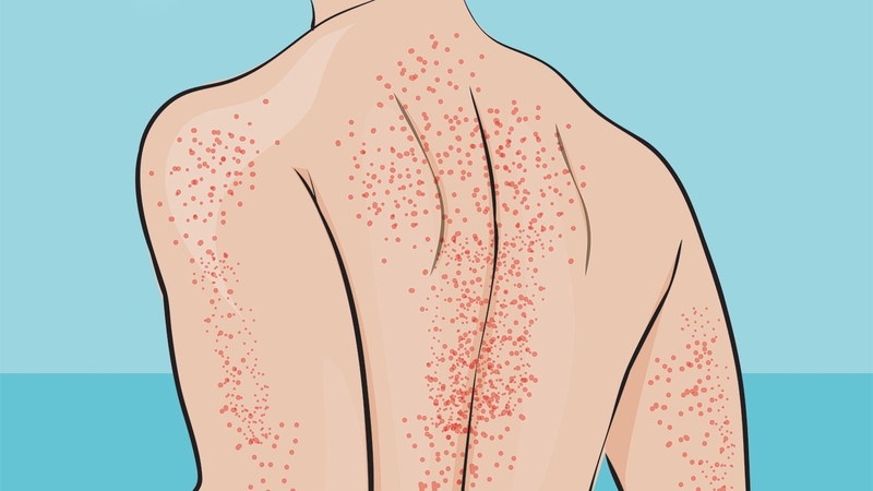 Xuất huyết giảm tiểu cầu miễn dịch có những triệu chứng gì? 2