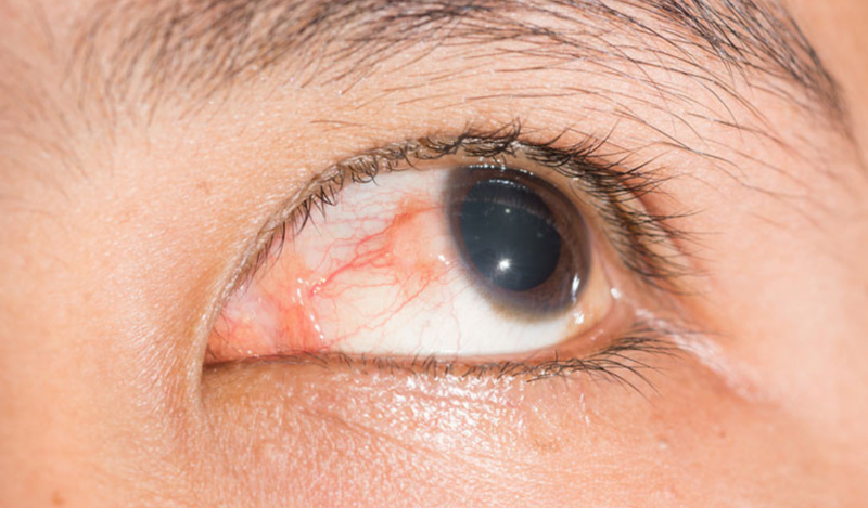 dấu hiệu của xuất huyết mắt