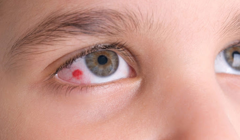 xuất huyết mắt có nguy hiểm không