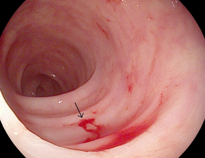 Xuất huyết tiêu hóa trên là gì? Dấu hiệu, nguyên nhân và cách xử trí 1
