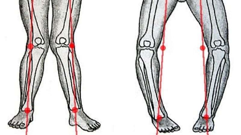 Xương cẳng chân bị cong: Nguyên nhân và cách khắc phục cho trẻ 1