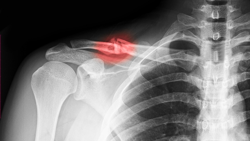 Xương đòn là gì? Xương đòn có chức năng gì? 3