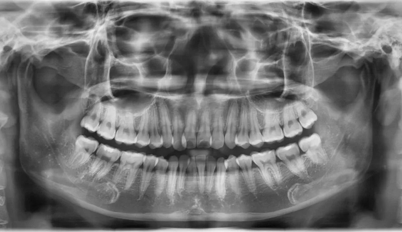 Xương hàm mỏng có niềng răng được không 1