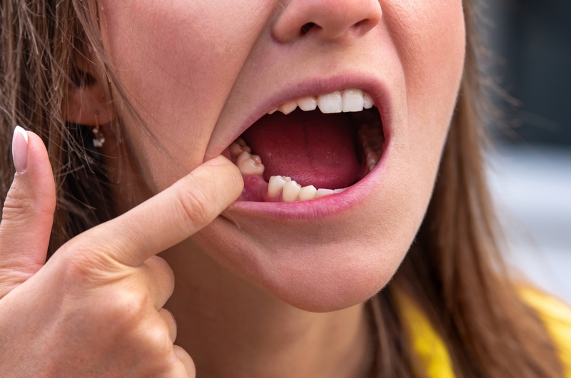 Xương hàm mỏng có niềng răng được không 2