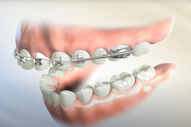 Xương hàm mỏng có niềng răng được không 3