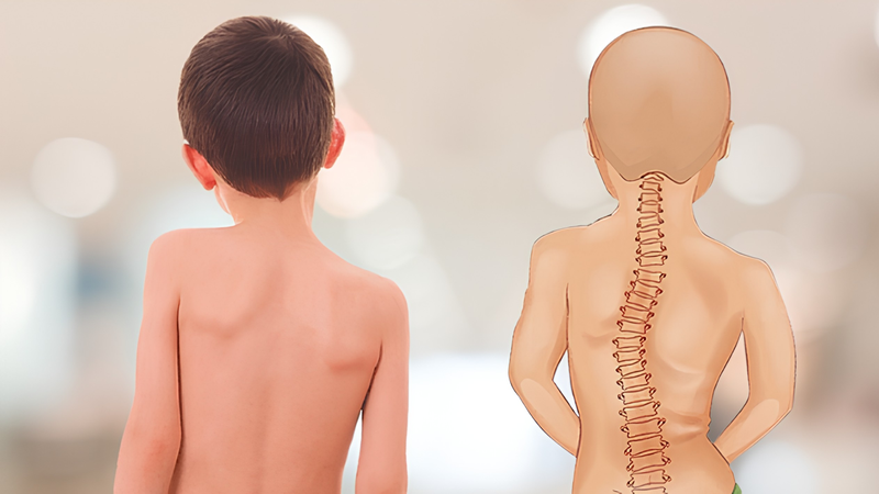 Vẹo cột sống là một trong những nguyên nhân phổ biến gây bất đối xứng lồng ngực