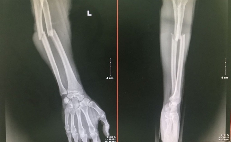 Xương trụ: Tìm hiểu cấu tạo, chức năng và các bệnh lý liên quan đến xương trụ 1