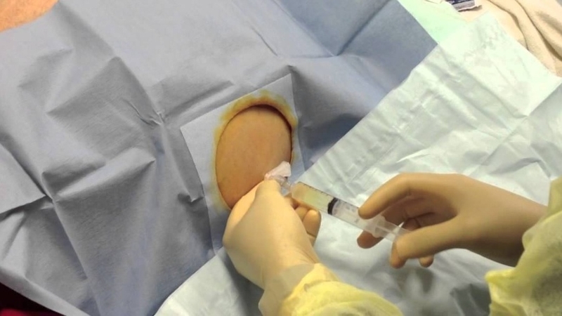 Ý nghĩa của xét nghiệm dịch màng bụng trong chẩn đoán bệnh 3