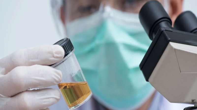 Ý nghĩa của xét nghiệm nitrit trong nước tiểu 1