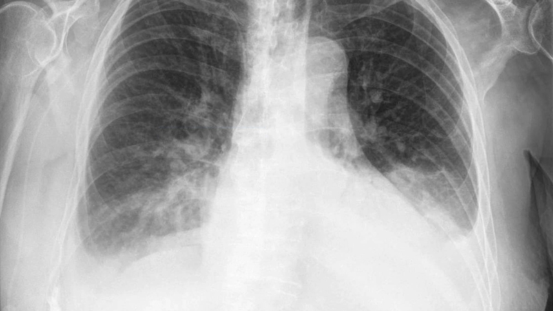 Ý nghĩa của xét nghiệm Rivalta trên lâm sàng 1