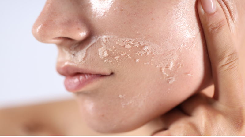 Lựa chọn phương pháp peel phù hợp giúp tối ưu hiệu quả chăm sóc da