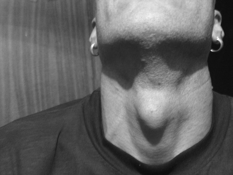 Yết hầu là gì? Yết hầu là phần xương sụn bao bọc phần thanh quản