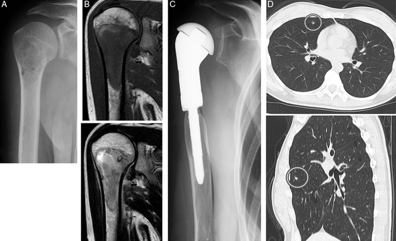 Yếu tố nguy cơ gây Ewing Sarcoma ở trẻ em và thanh thiếu niên 1