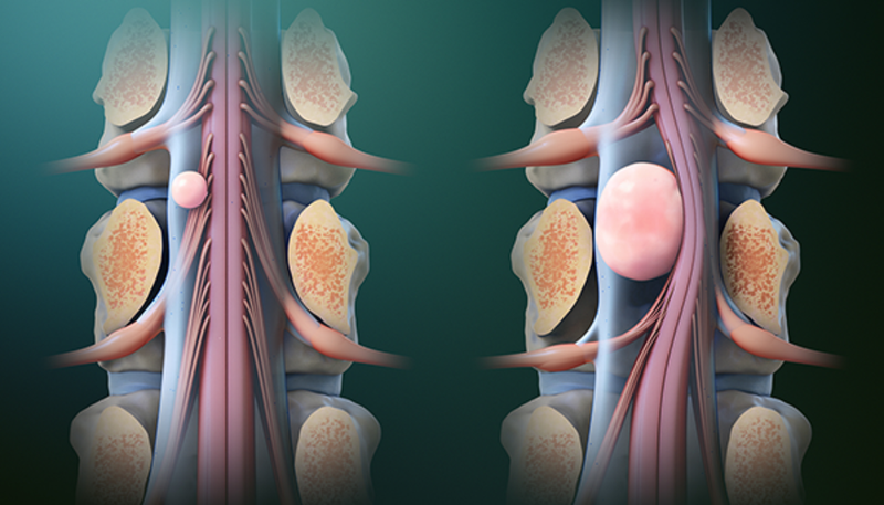 Yếu tố nguy cơ gây u tế bào mầm ở trẻ em - Không thể bỏ qua! 1