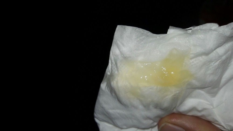 [Góc giải đáp] Thế nào là nút nhầy cổ tử cung? 3