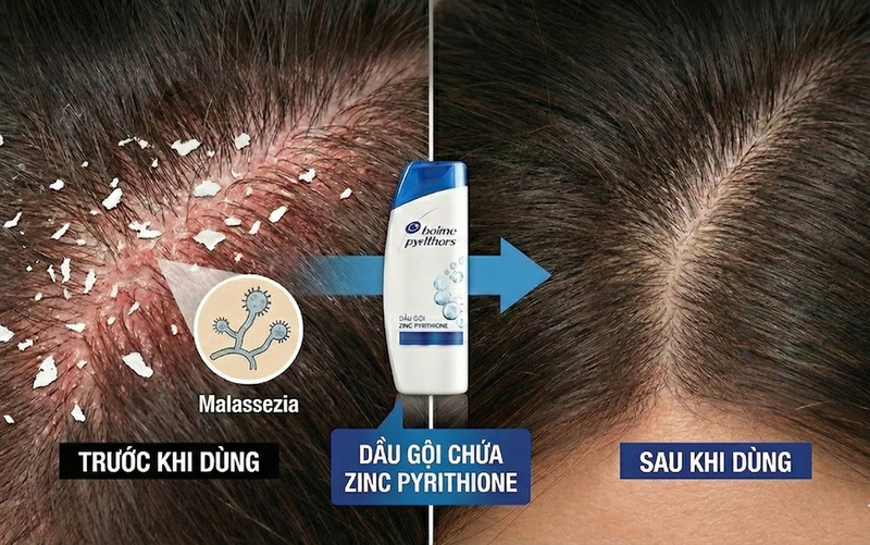 Zinc pyrithione tạo hàng rào bảo vệ giúp da đầu duy trì trạng thái sạch gàu