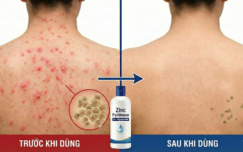 Zinc pyrithione giúp làm sạch và kiểm soát vùng da bị mụn nấm
