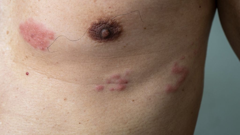 Zona ở bụng: Cách điều trị và chăm sóc 1