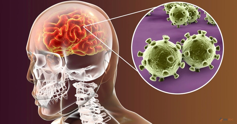 Zona ở tai có thể gây viêm màng não 3