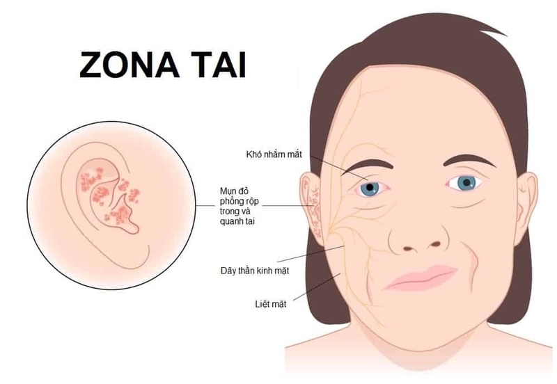 Zona ở tai có thể gây viêm màng não 2