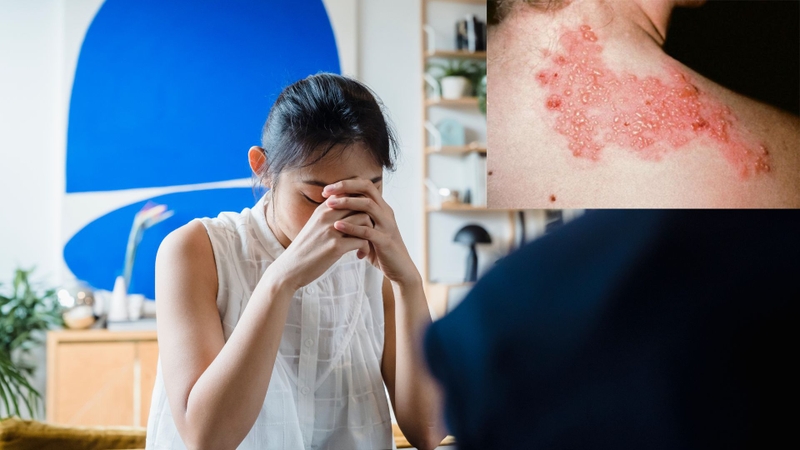 Zona thần kinh có gây vô sinh không? Giải đáp từ chuyên gia y tế 1