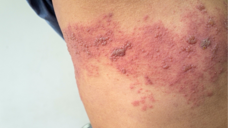 Zona thần kinh ở lưng: Triệu chứng, nguyên nhân và cách điều trị hiệu quả 1