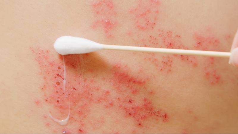 Zona thần kinh ở lưng: Triệu chứng, nguyên nhân và cách điều trị hiệu quả 4