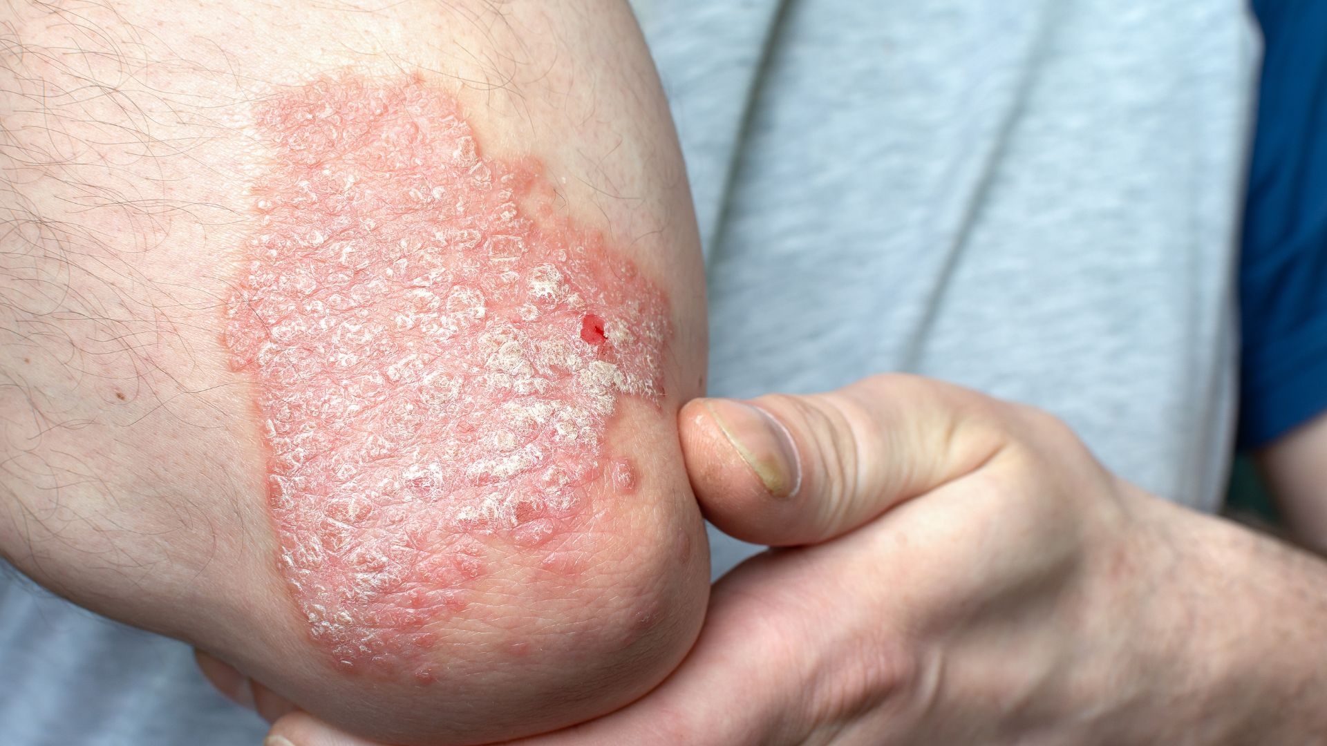 Hình ảnh Secukinumab