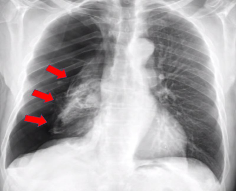 Коллапс легкого это. Pneumothorax XRAY. Коллапс лёгкого рентген. Пневмоторакс исследования рентген легких.