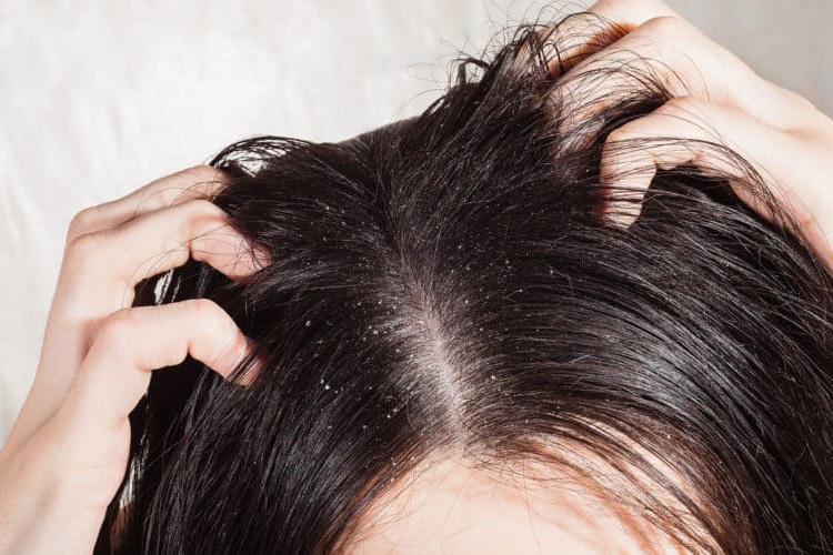 Đầu nhiều gàu, tóc rụng có nguy hiểm không - Nhà thuốc FPT Long Châu