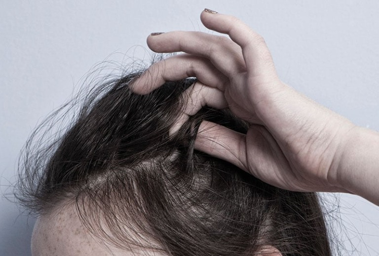 Rối loạn nhổ tóc: Nhổ tóc có mọc lại được không? - Nhà thuốc FPT Long Châu