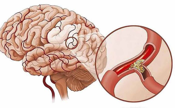 Giải pháp hỗ trợ bệnh rối loạn tuần hoàn não, thiếu máu lên não - Nhà thuốc  FPT Long Châu