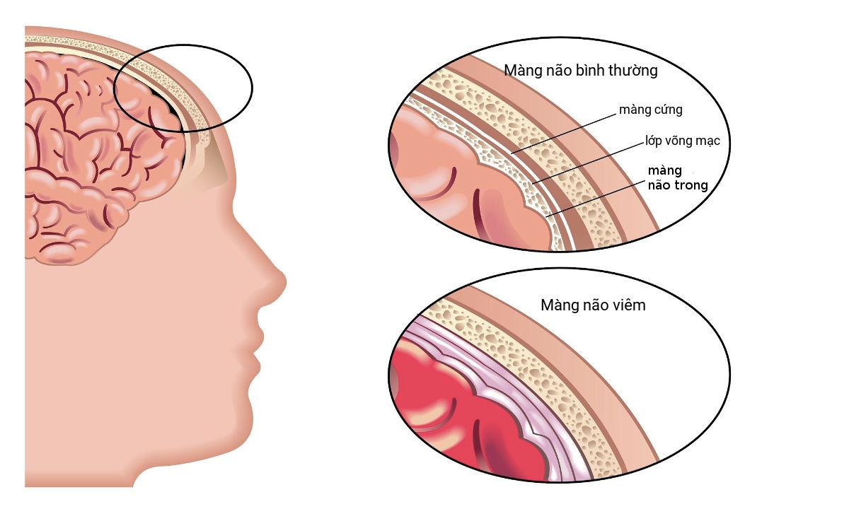 Hình ảnh bệnh viêm não Nhật bản bạn cần biết - Nhà thuốc FPT Long Châu