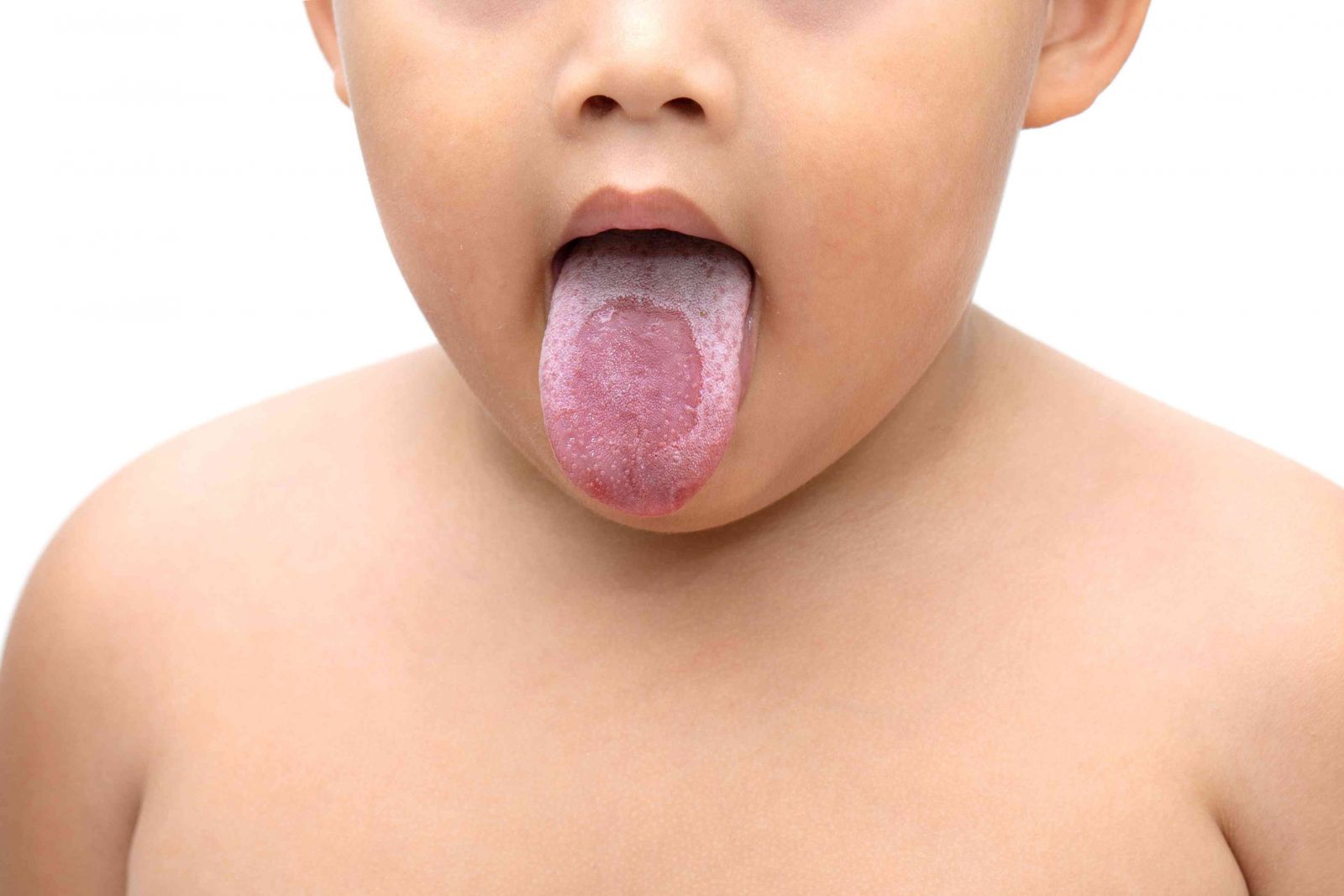 Một số hình ảnh nấm miệng ở trẻ sơ sinh - Nhà thuốc FPT Long Châu
