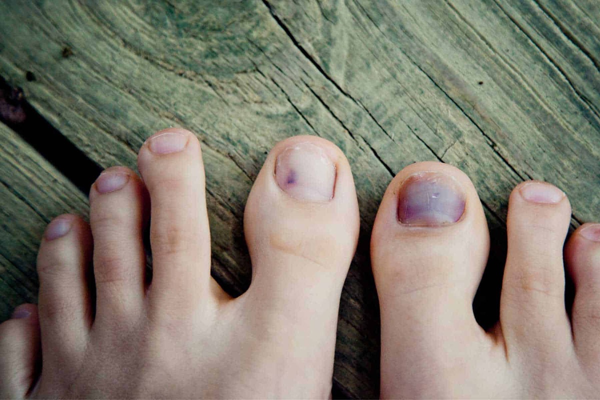 Móng chân bị đen: bệnh liên quan đến móng chân
Nếu bạn phát hiện rằng móng chân của mình đen thì có thể đây là dấu hiệu của một số loại bệnh liên quan đến móng chân. Hãy xem hình ảnh liên quan và tìm hiểu thêm về các loại bệnh này và cách điều trị hiệu quả để giữ cho móng chân của bạn luôn khỏe mạnh.