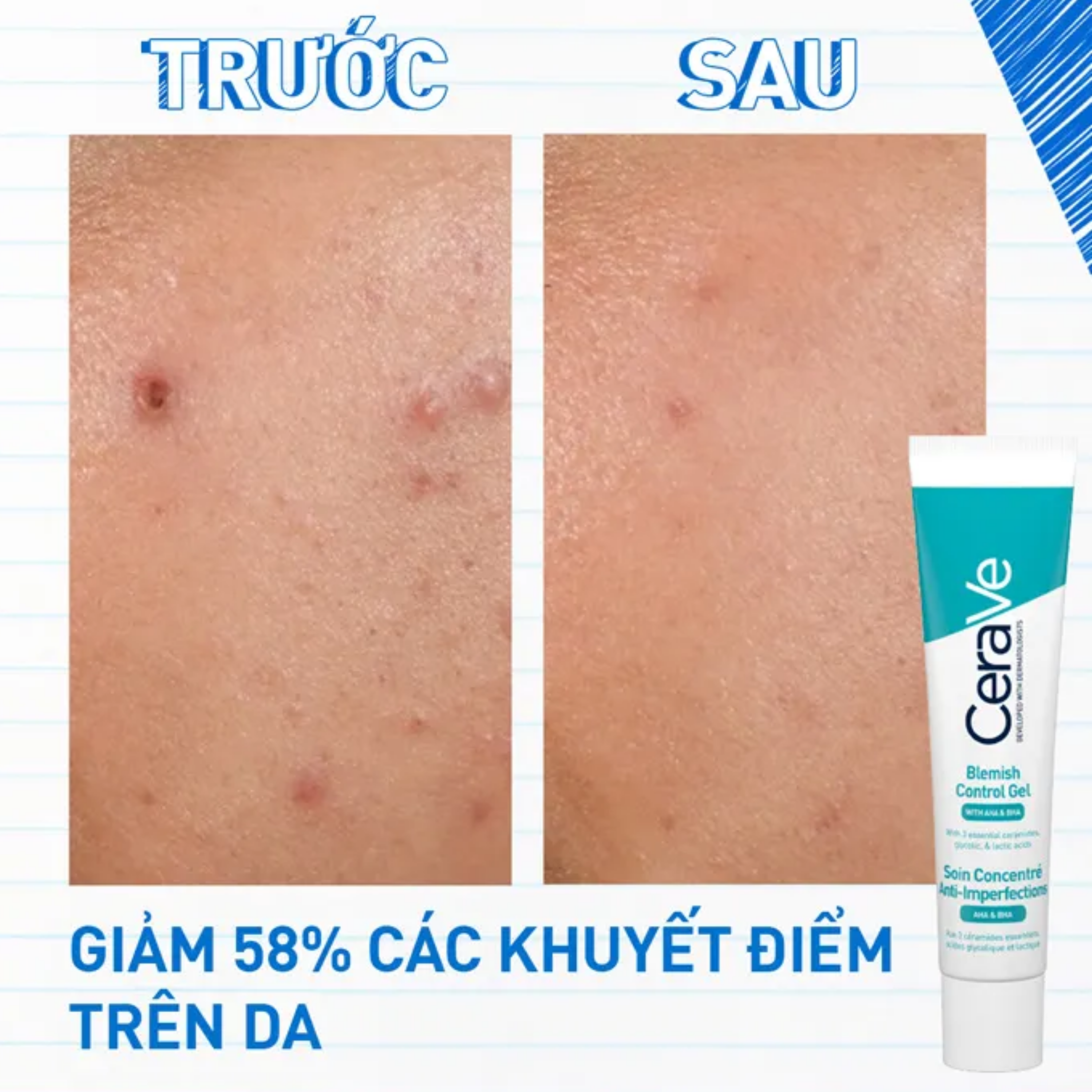 Hình ảnh Gel giảm mụn Cerave Blemish Control 15ml