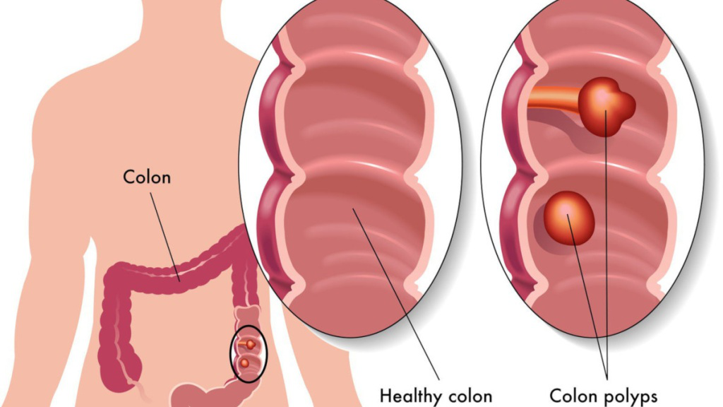 Chi phí cắt polyp đại tràng khoảng bao nhiêu tiền?