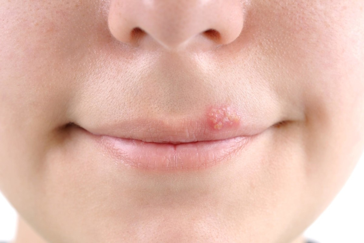 Cách phòng ngừa bệnh cold sore?
