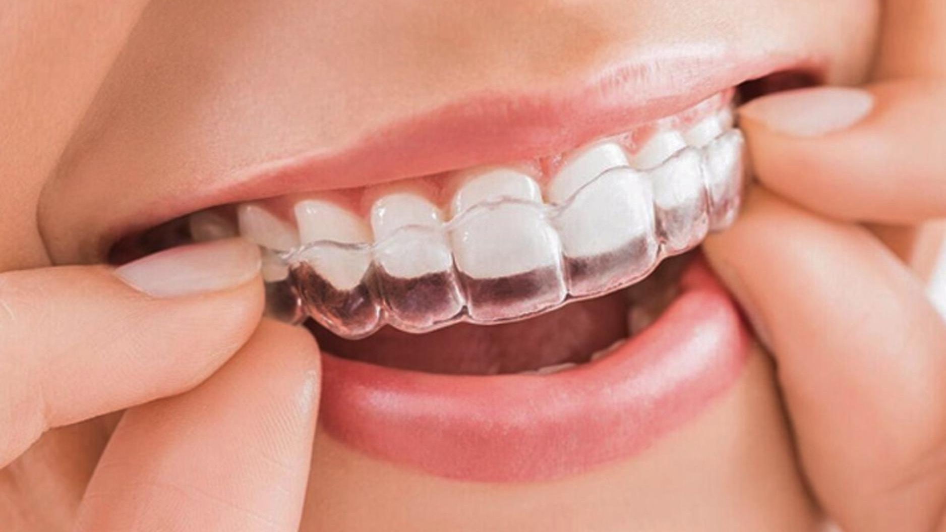 Có những phương pháp niềng răng phổ biến nào dành cho người 16 tuổi?
