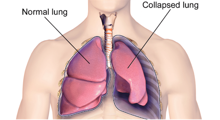 Những triệu chứng khác như thở nhanh, đau ngực có thể gây ra bởi xẹp phổi hay không?
