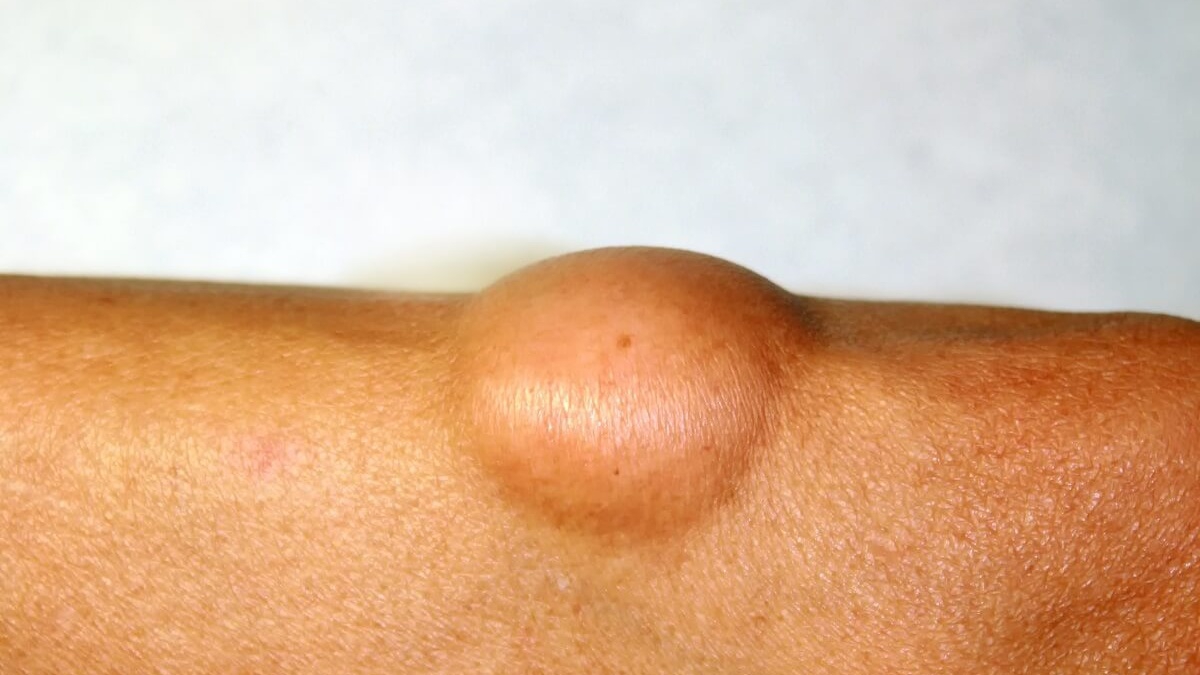 Lipoma (u mỡ) là gì? Có nguy hiểm không?