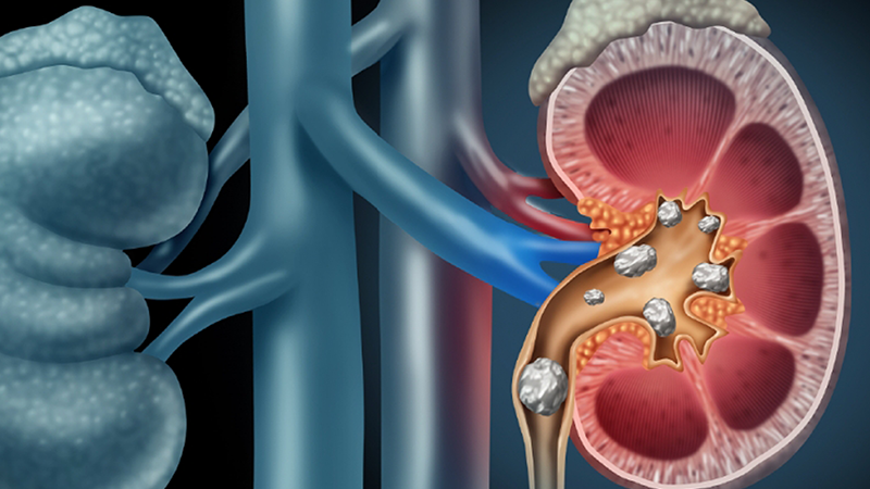 Sỏi thận có thể tự đào thải không? Cách đẩy sỏi thận ra ngoài hiệu quả
