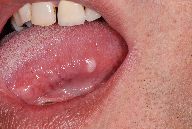 Lưỡi bình thường và các bệnh lý về lưỡi thường gặp 4