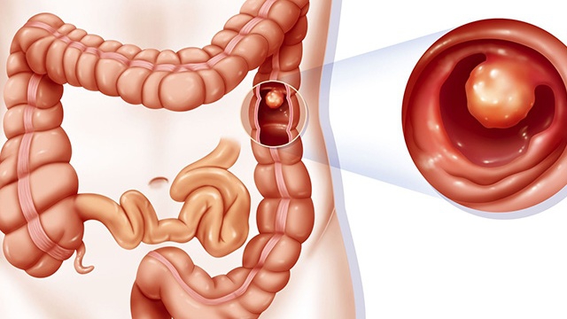 Hỏi đáp: Kết quả sinh thiết polyp đại tràng ác tính khi nào?